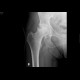 Aseptic necrosis of the femoral head: X-ray - Plain radiograph